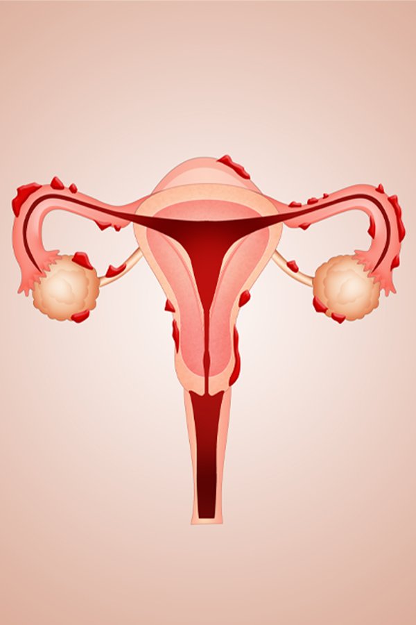 endometriosis treatment bernhoft ojai